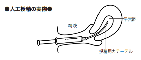 人工授精イメージ図