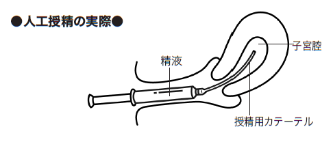 人工授精の実際