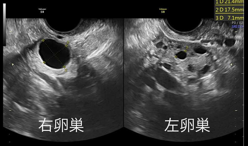 右卵巣と左卵巣③