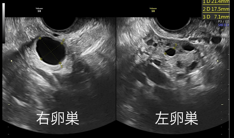右卵巣と左卵巣③